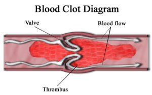 deep vein thrombosis