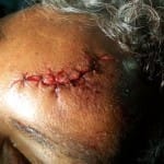 scalp laceration after a fall