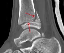 ankle fracture