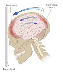 head injury in nursing home, falls in the nursing home